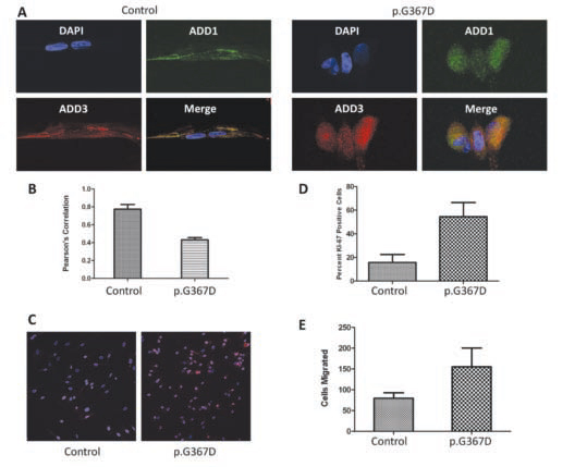 (A) Wild-type fibroblasts (left) show co-localization of ADD1 (red) and ADD3 (green) into functional heteromers (yellow merge) while ADD3 mutant fibroblasts from patients with inherited CP show impaired co-localization (discrete green and red puncta); (B-D) lesions in brains from drosophila lacking functional adducin; (E) flies deficient in adducin can’t walk as well as wild-type flies, recapitulating the human phenotype