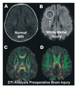 Preoperative Brain Injury in Newborns with Congenital Heart Disease.