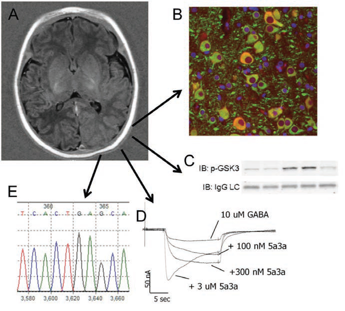 Functional, structural, and genetic studies of resected epileptic brain tissue.