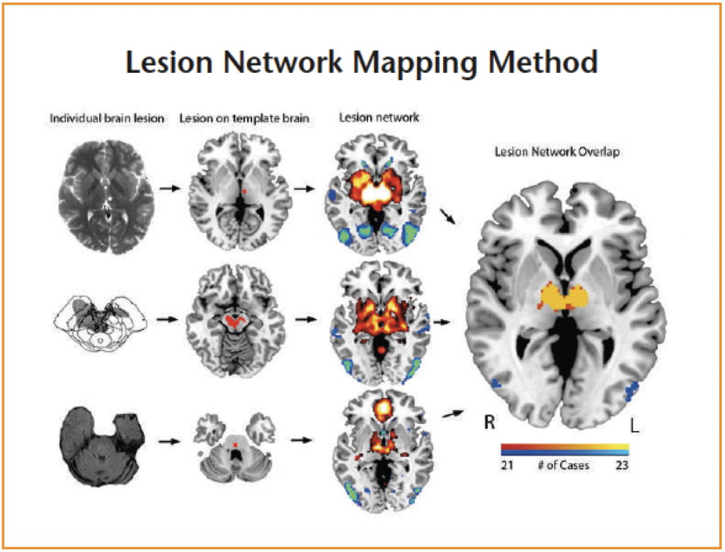 Lesion network mapping involves two steps. First, a brain lesion from a clinical scan is mapped onto a reference brain (columns 1 & 2).